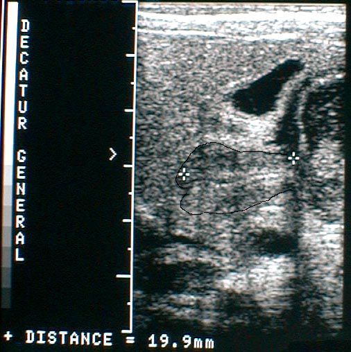 Ultrasound picture for the curious - 65K The outline shows the boundaries of 