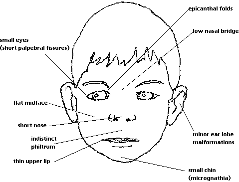 Flat Nasal Bridge And Epicanthal Folds / Fetal Alcohol ...