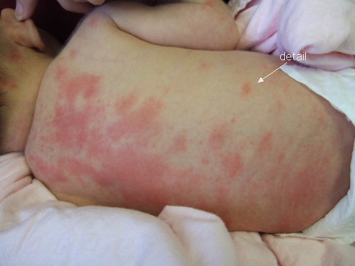 erythema toxicum